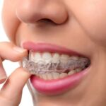 Invisible Braces, Visible Results: The Advantages of Invisalign in North Vancouver