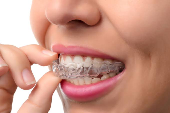 Invisible Braces, Visible Results: The Advantages of Invisalign in North Vancouver